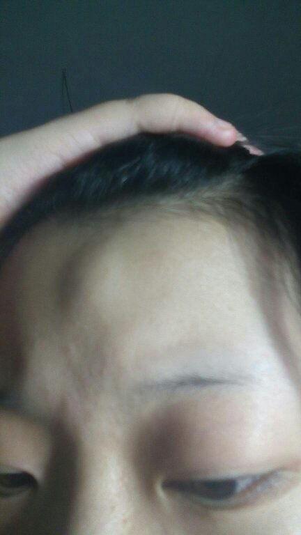 吃哈密瓜额头痒,额头奇痒背后的甜蜜谜团